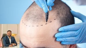 Health Talk: When, how and where to get hair transplant, know from hair transplant surgeon Health Talk: When, how and where to get hair transplant, know from hair transplant surgeon